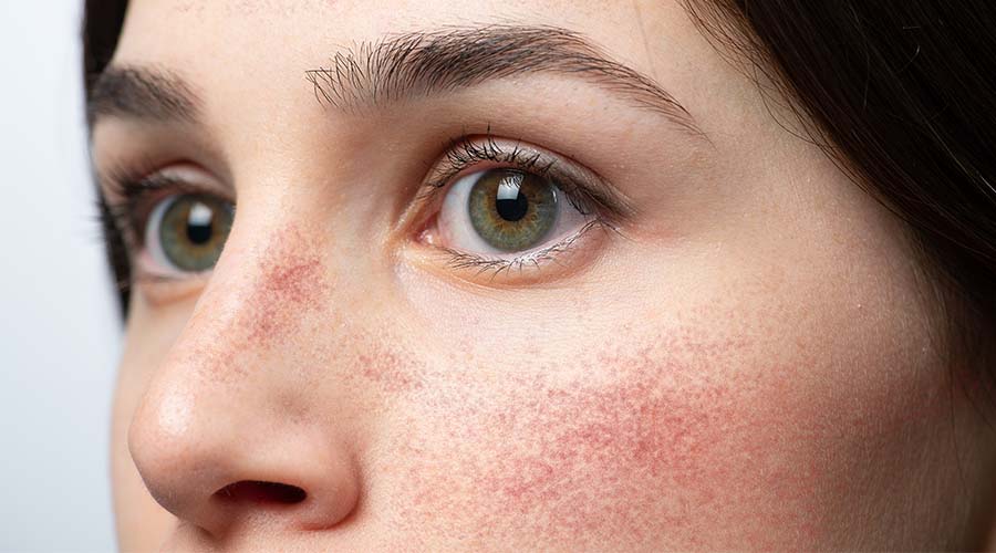 Zoom visage femme brune aux yeux verts avec rougeurs et rosacées sur la peau